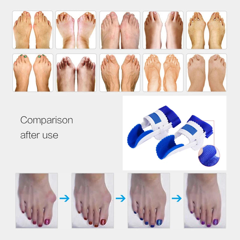 Bunion Splint Straightener Big Toe Corrector Foot Pain Relief Hallux Valgus Correction Orthopedic Bone Thumb Foot Care Tools